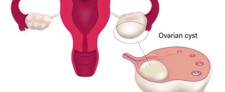 Natural Remedies For Ovarian Cysts: Natural Ways Every Woman Must Know Natural Remedies For Ovarian Cysts: Natural Ways Every Woman Must Know